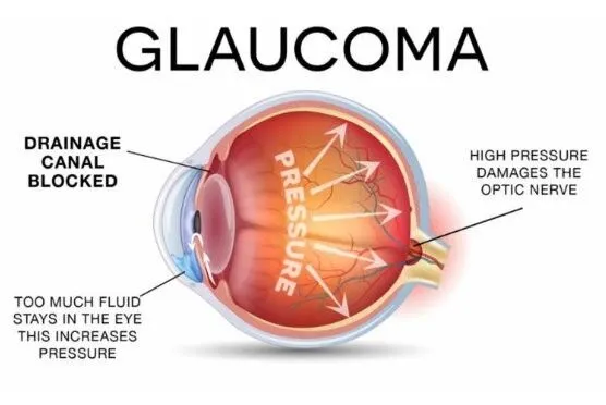 Glaucoma Prevention – How to Avert Vision Loss