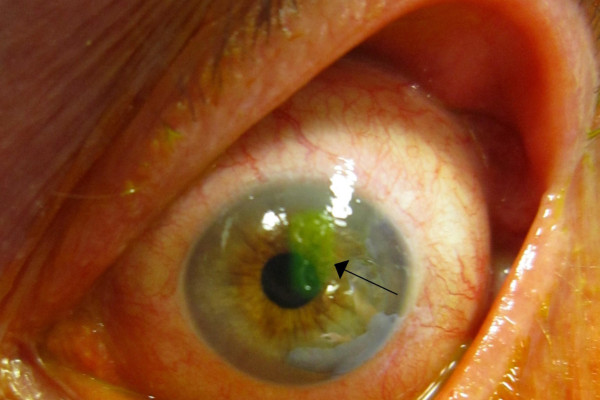 Recurrent Corneal Erosion Treatment by Dr. Amit Jain in eye hospital Dubai