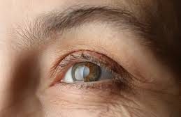 Blurry to Blind? Understanding the Link Between Myopia, Cataracts & Glaucoma
