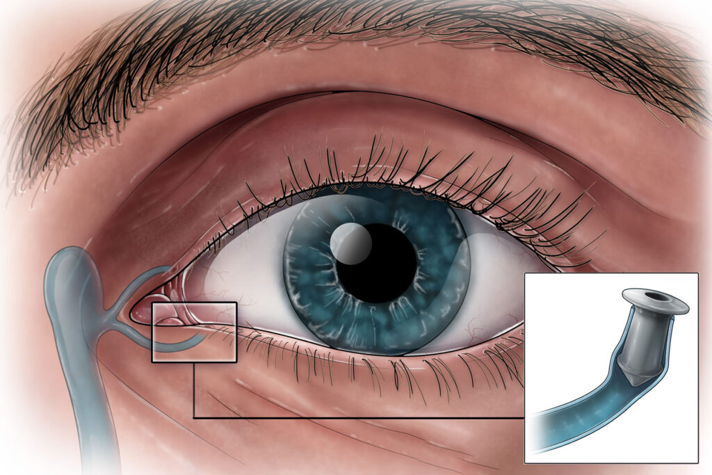 Dry Eye Solutions: How Punctal and Silicone Plugs Can Help