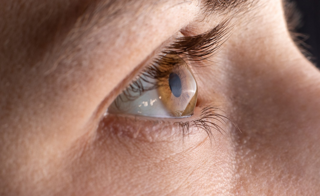 Living with Keratoconus: Tips for Clear Vision and Comfort